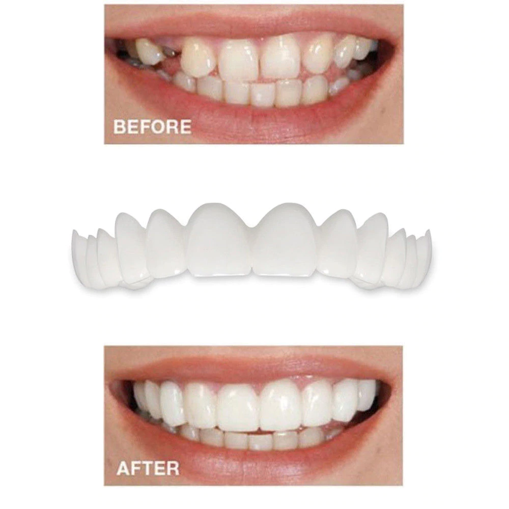 InstaSmile Snap-On Veneers