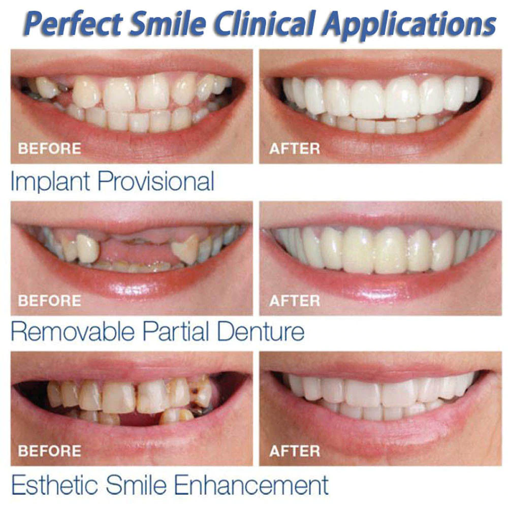 InstaSmile Snap-On Veneers