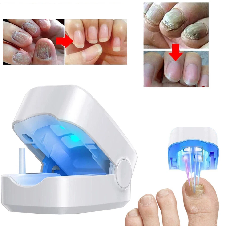 NailPure Beam – Nagelpilz-Behandlungslicht