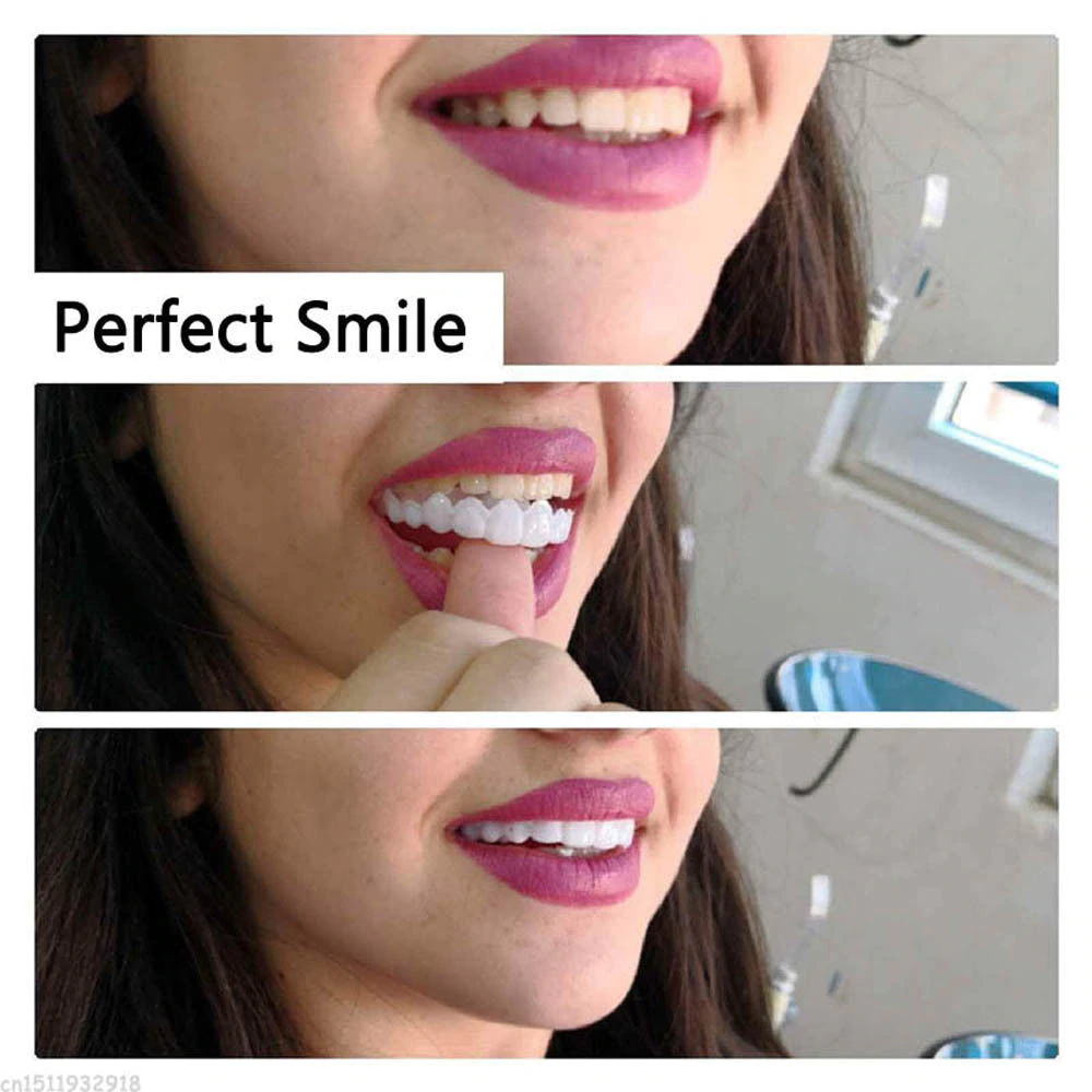 InstaSmile Snap-On Veneers