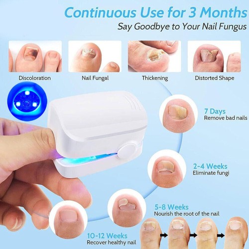 NailPure Beam – Nagelpilz-Behandlungslicht