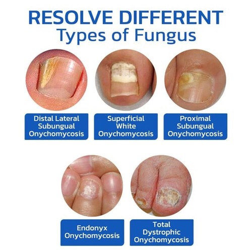 NailPure Beam – Nagelpilz-Behandlungslicht